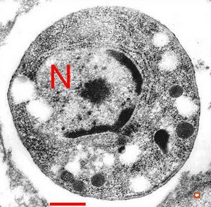 F,69y. | Toxoplasma gondii … brain … (radiation and chemotherapy) F,69y. | Toxoplasma gondii … brain … (radiation and chemotherapy)